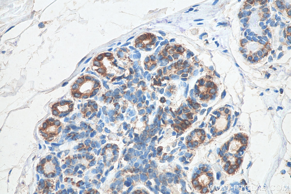 Immunohistochemistry (IHC) staining of human breast cancer tissue using CXCR4 Monoclonal antibody (60042-1-Ig)