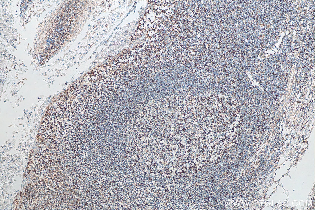 IHC staining of human tonsillitis using 60042-1-Ig