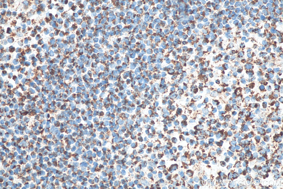 Immunohistochemistry (IHC) staining of human tonsillitis tissue using CXCR4 Monoclonal antibody (60042-1-Ig)