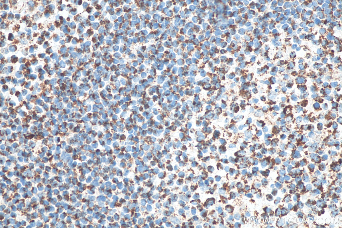 IHC staining of human tonsillitis using 60042-1-Ig