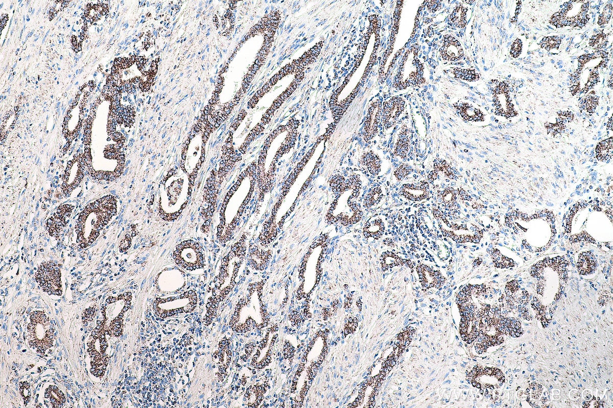 Immunohistochemistry (IHC) staining of human prostate cancer tissue using CXCR4 Monoclonal antibody (60042-1-Ig)