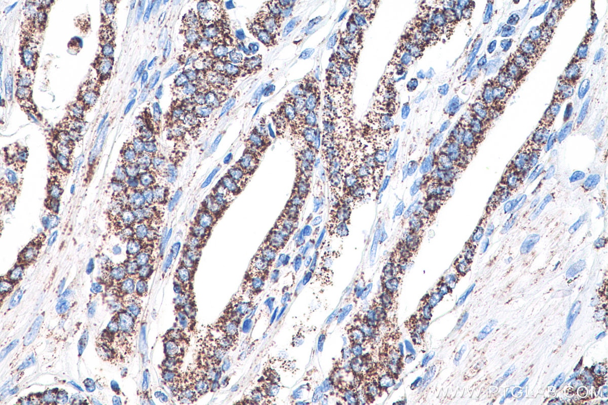 Immunohistochemistry (IHC) staining of human prostate cancer tissue using CXCR4 Monoclonal antibody (60042-1-Ig)