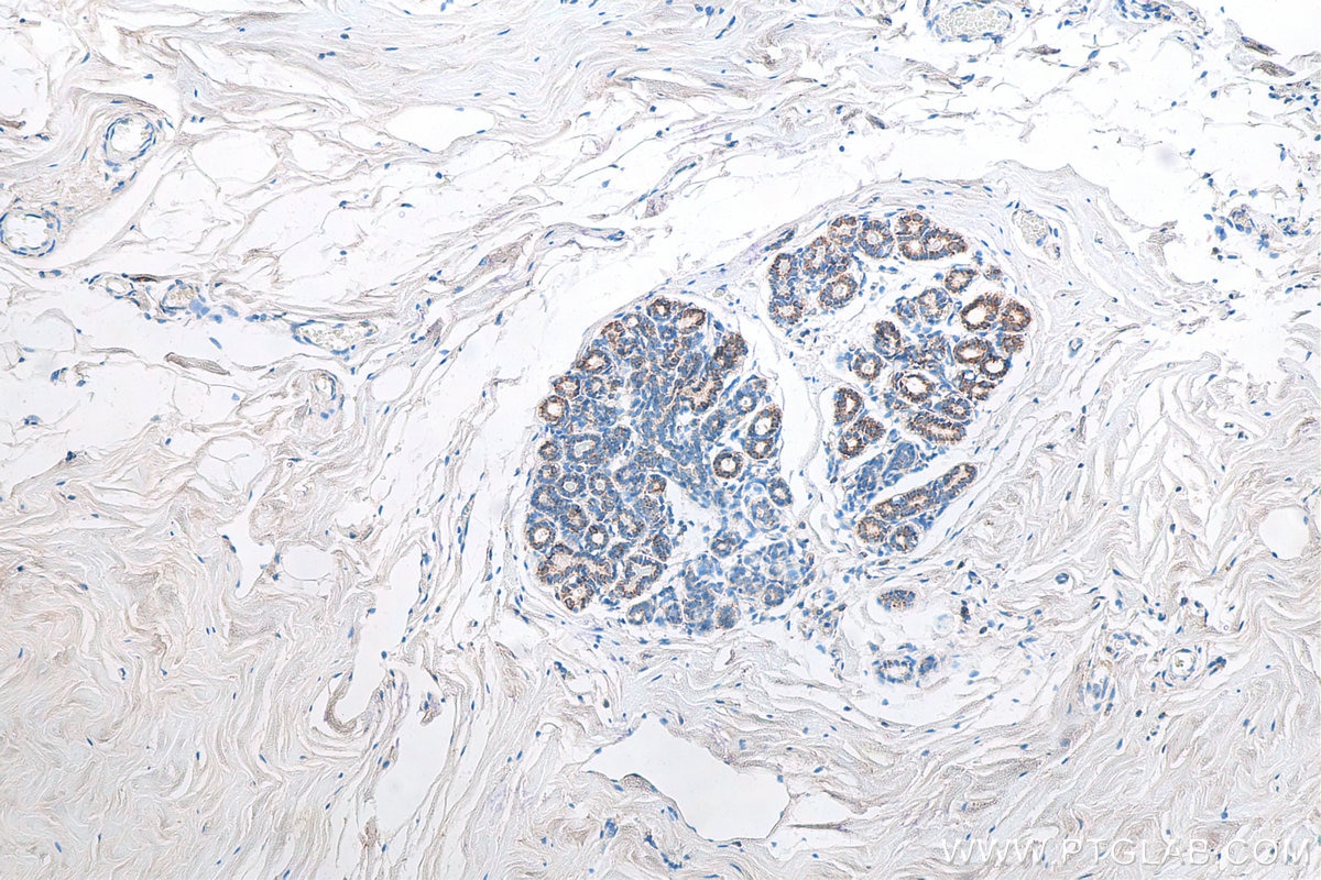 Immunohistochemistry (IHC) staining of human breast cancer tissue using Biotin-conjugated CXCR4 Monoclonal antibody (Biotin-60042)