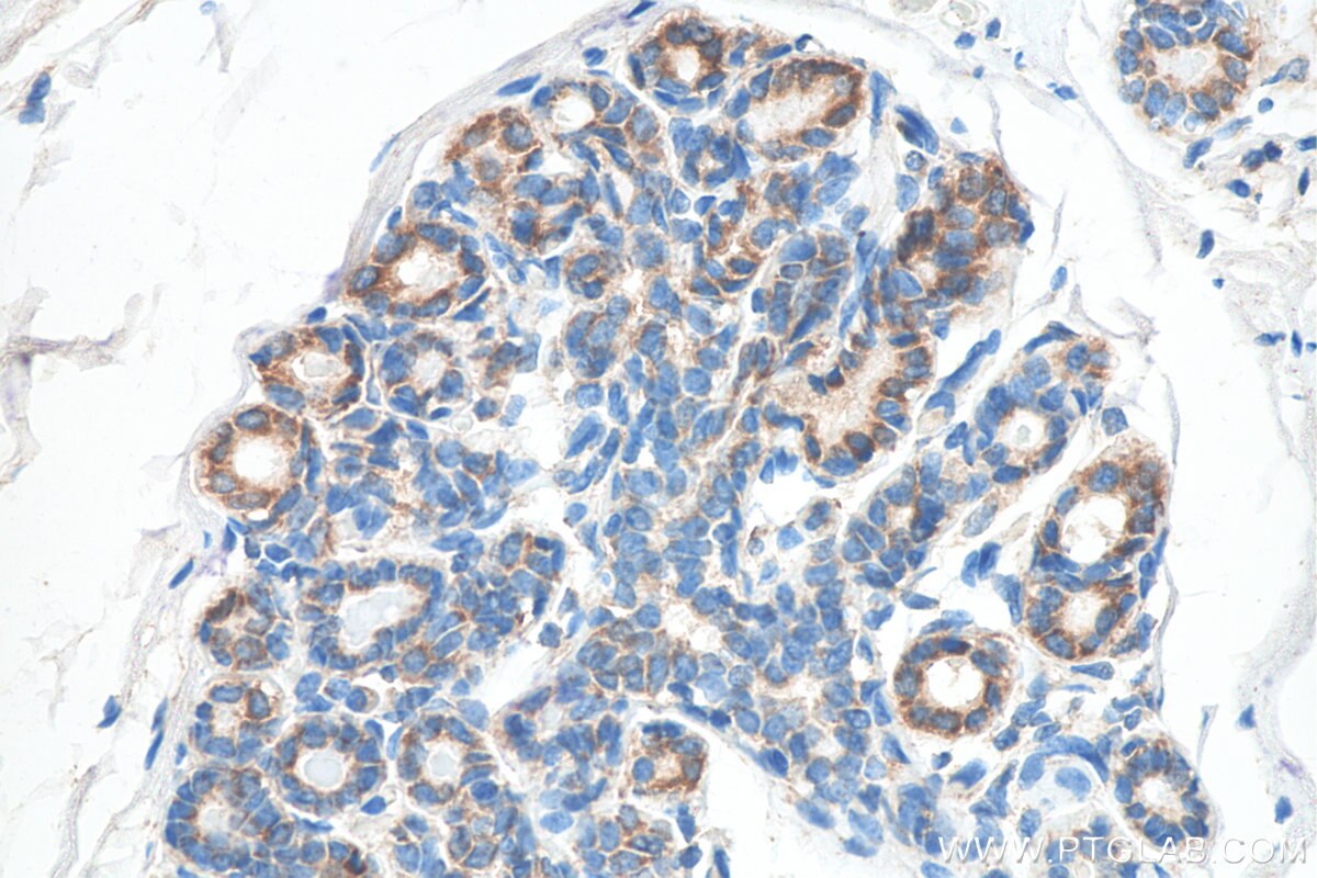 Immunohistochemistry (IHC) staining of human breast cancer tissue using Biotin-conjugated CXCR4 Monoclonal antibody (Biotin-60042)