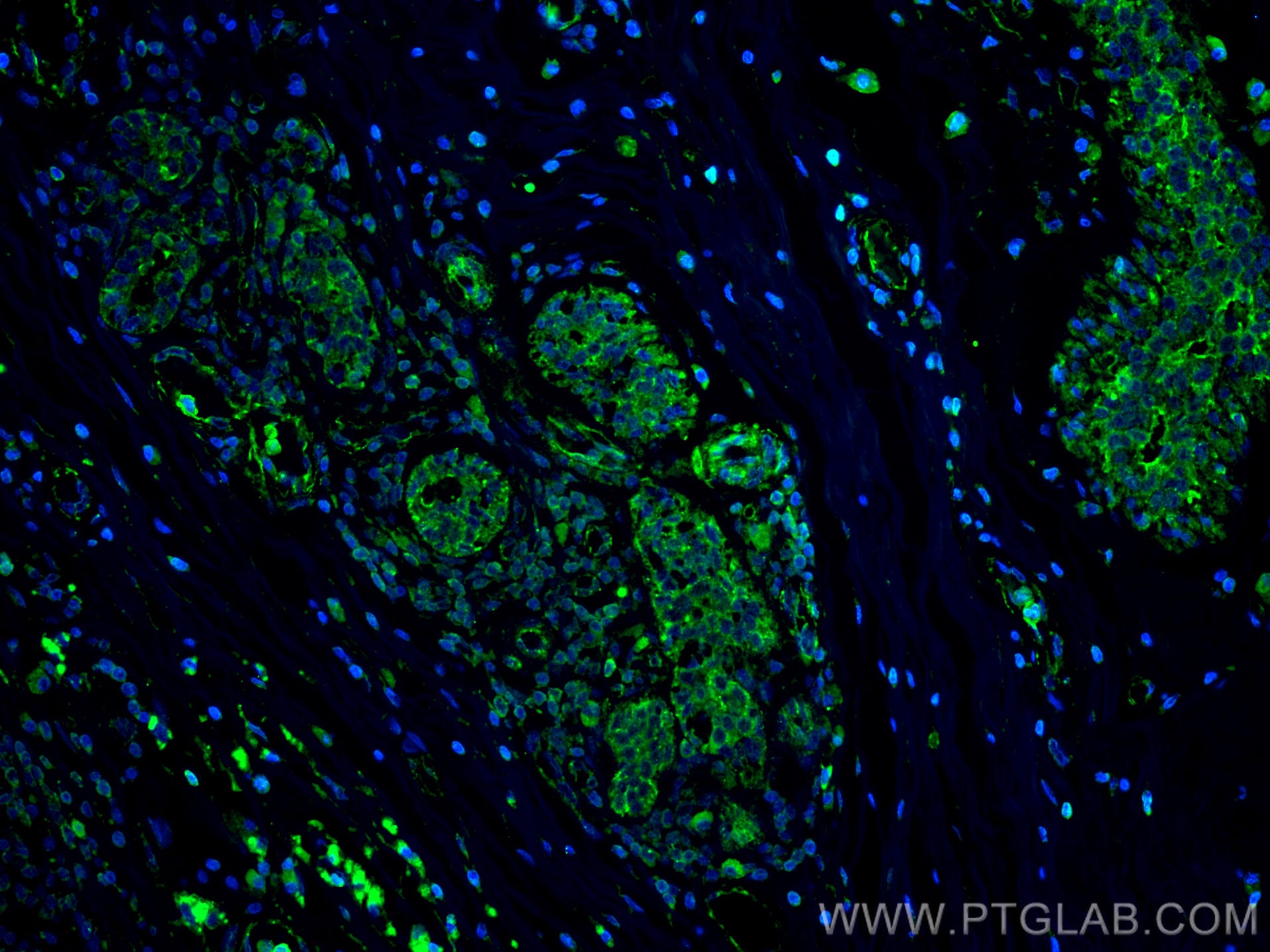 Immunofluorescence (IF) / fluorescent staining of human breast cancer tissue using CXCR7 Monoclonal antibody (60216-1-Ig)