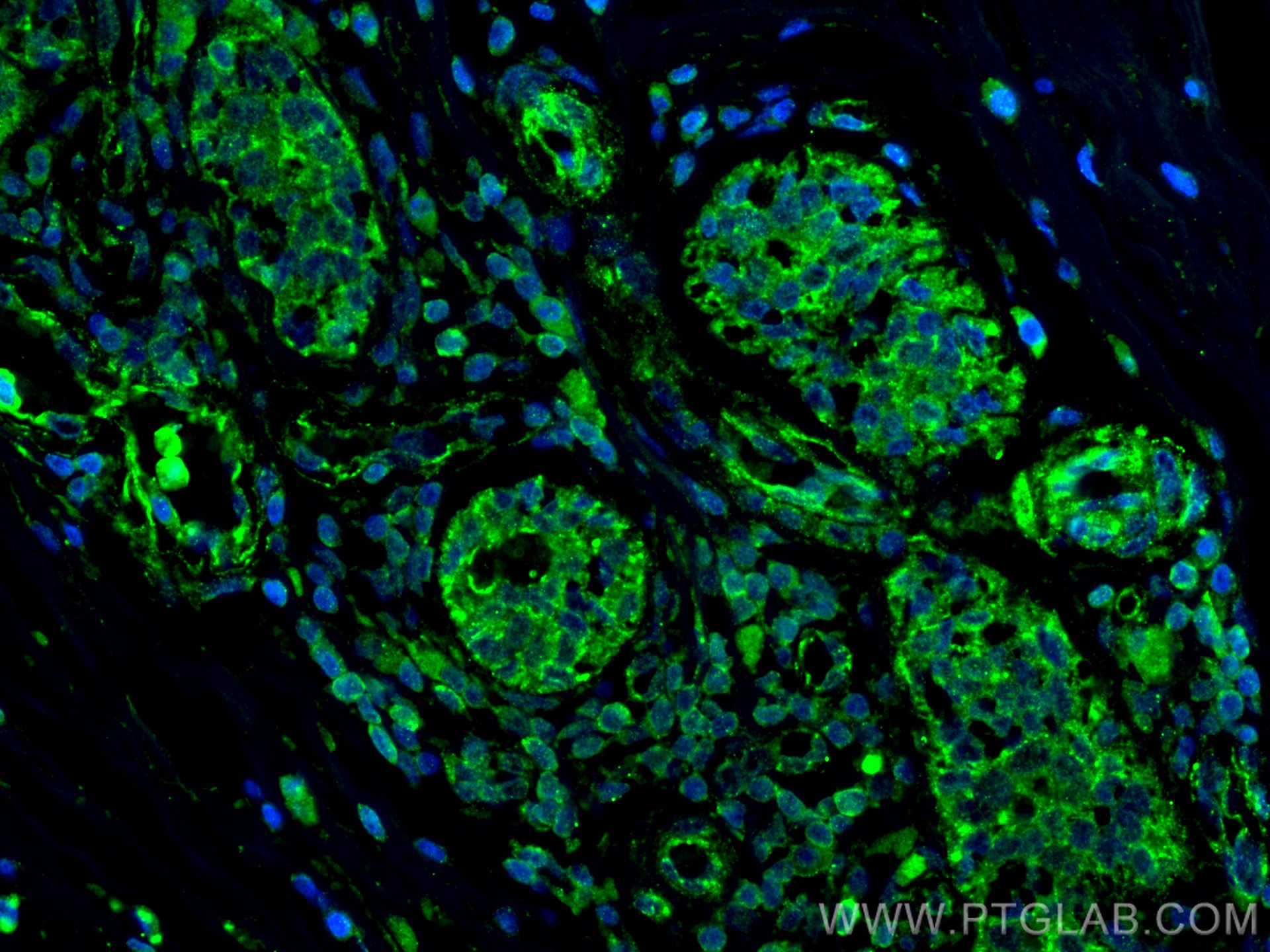 IF Staining of human breast cancer using 60216-1-Ig