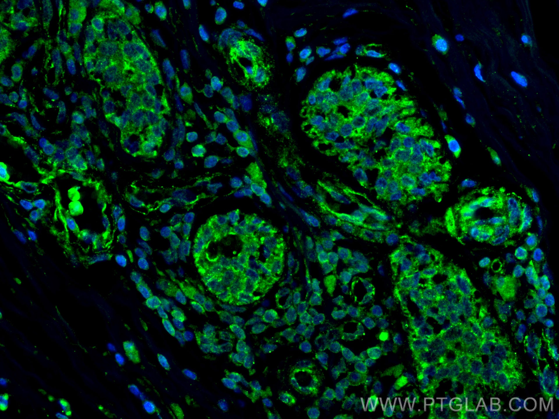 Immunofluorescence (IF) / fluorescent staining of human breast cancer tissue using CXCR7 Monoclonal antibody (60216-1-Ig)