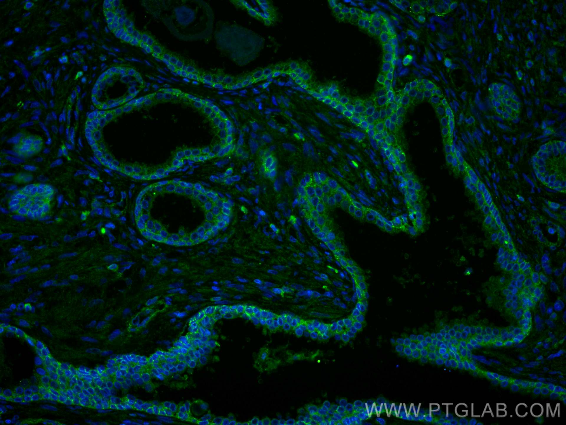 Immunofluorescence (IF) / fluorescent staining of human prostate cancer tissue using CXCR7 Monoclonal antibody (60216-1-Ig)
