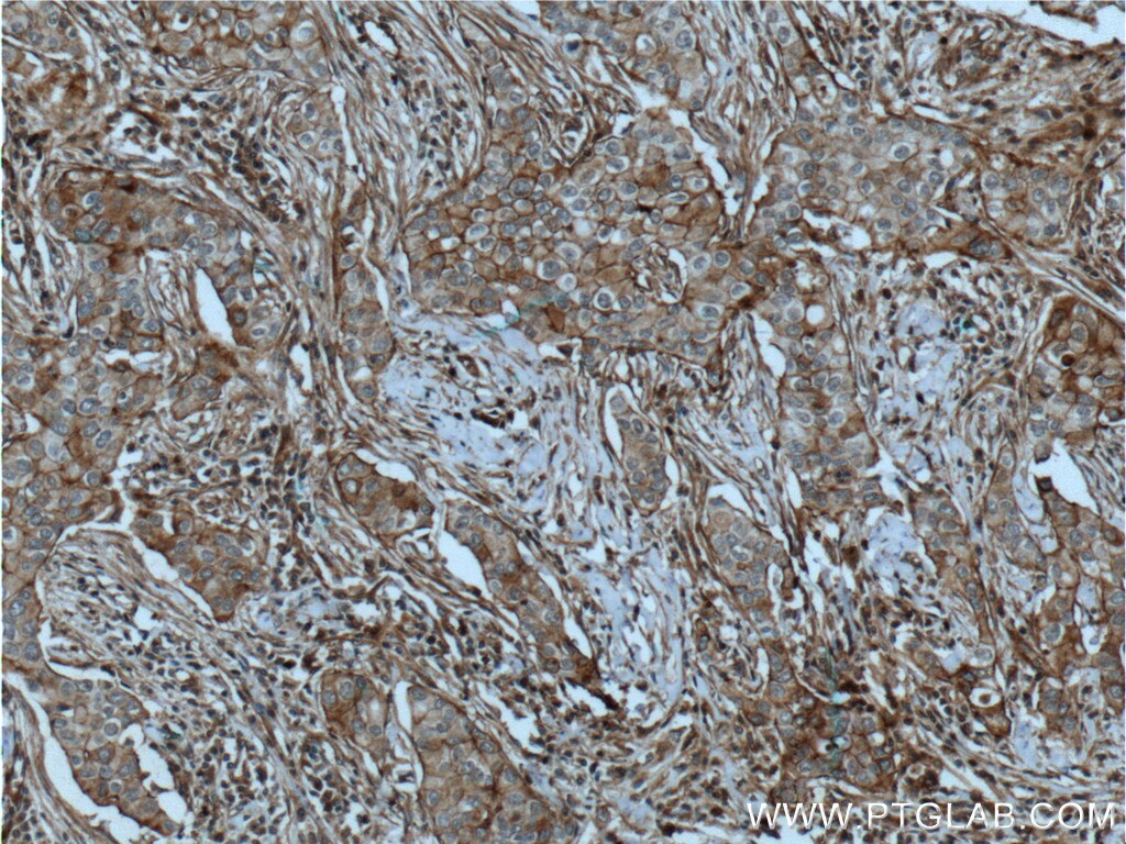 IHC staining of human breast cancer using 60216-1-Ig