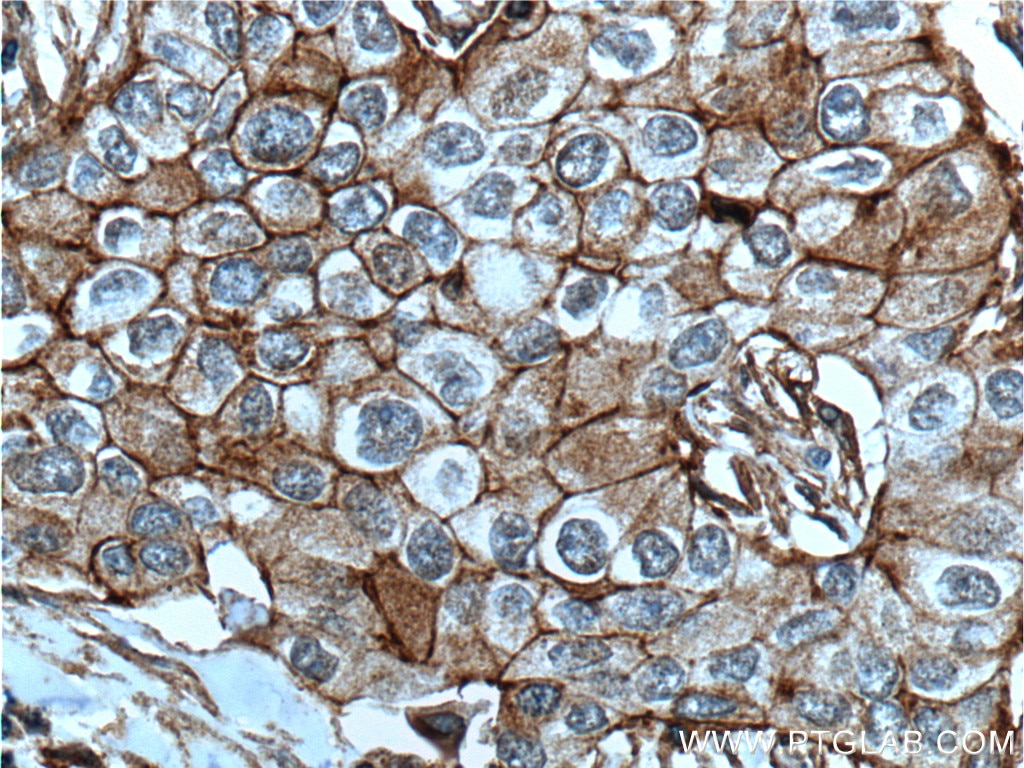 Immunohistochemistry (IHC) staining of human breast cancer tissue using CXCR7 Monoclonal antibody (60216-1-Ig)