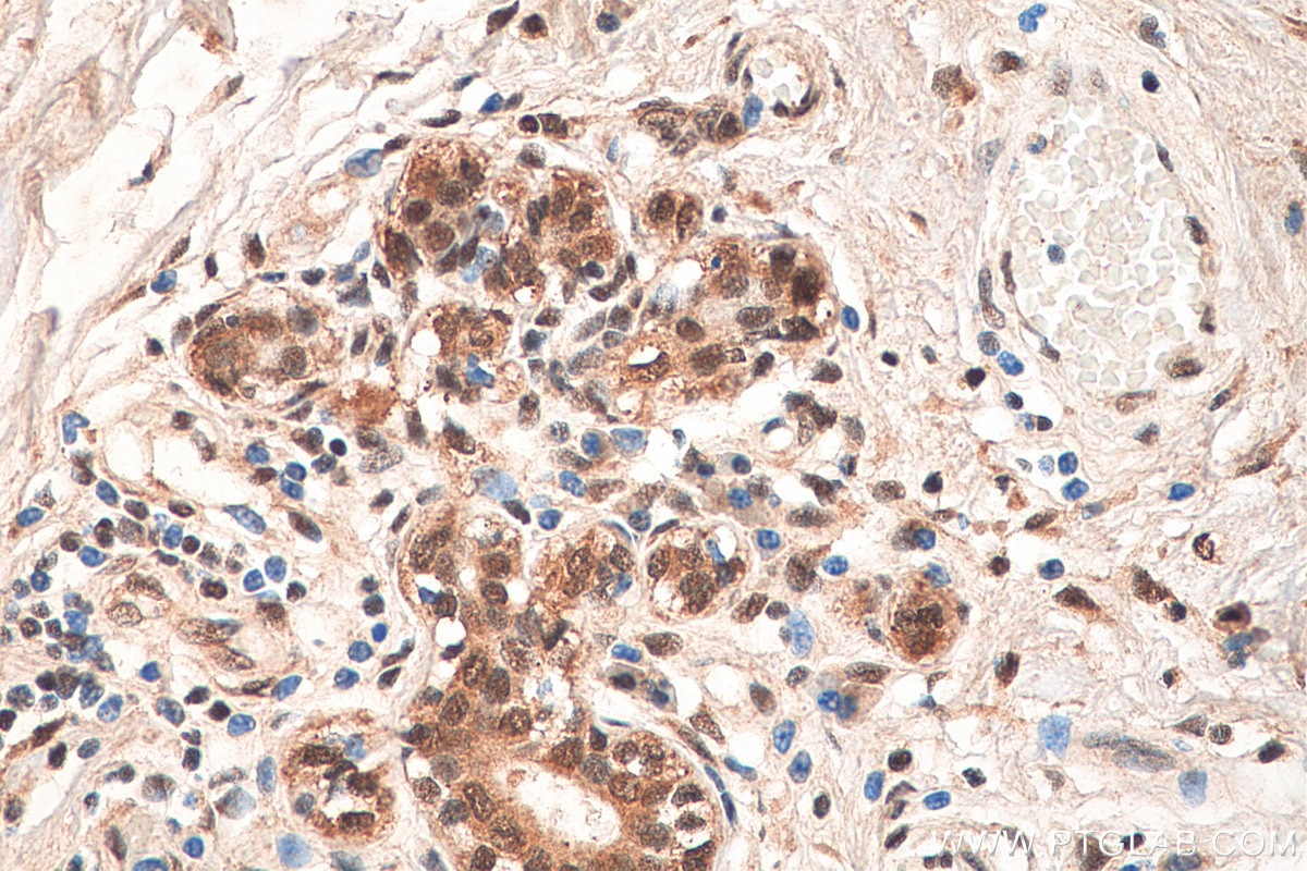 Immunohistochemistry (IHC) staining of human breast cancer tissue using CXXC1 Polyclonal antibody (27963-1-AP)