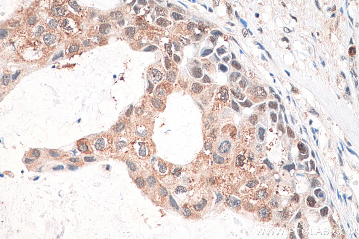 Immunohistochemistry (IHC) staining of human breast cancer tissue using CXXC1 Polyclonal antibody (27963-1-AP)