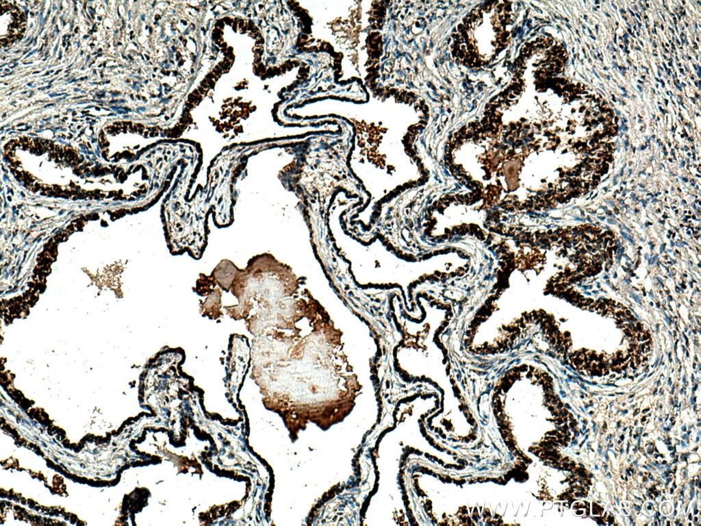 Immunohistochemistry (IHC) staining of human prostate cancer tissue using CXXC5 Polyclonal antibody (16513-1-AP)