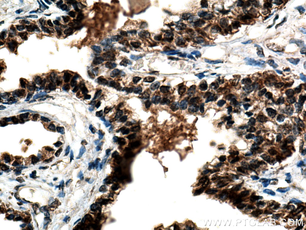 Immunohistochemistry (IHC) staining of human prostate cancer tissue using CXXC5 Polyclonal antibody (16513-1-AP)