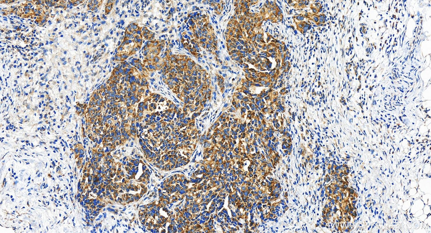 Immunohistochemistry (IHC) staining of human ovary cancer tissue using CXorf15 Polyclonal antibody (22357-1-AP)