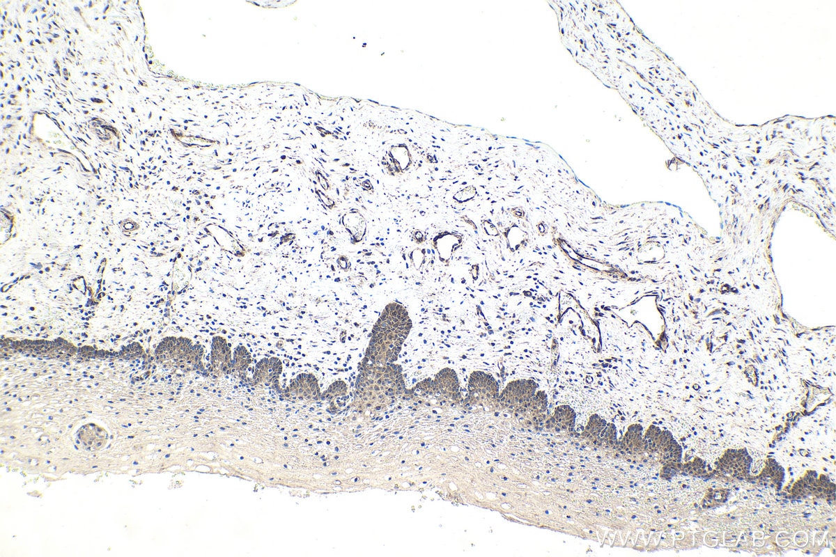 Immunohistochemistry (IHC) staining of human cervical cancer tissue using CXorf21 Polyclonal antibody (30244-1-AP)