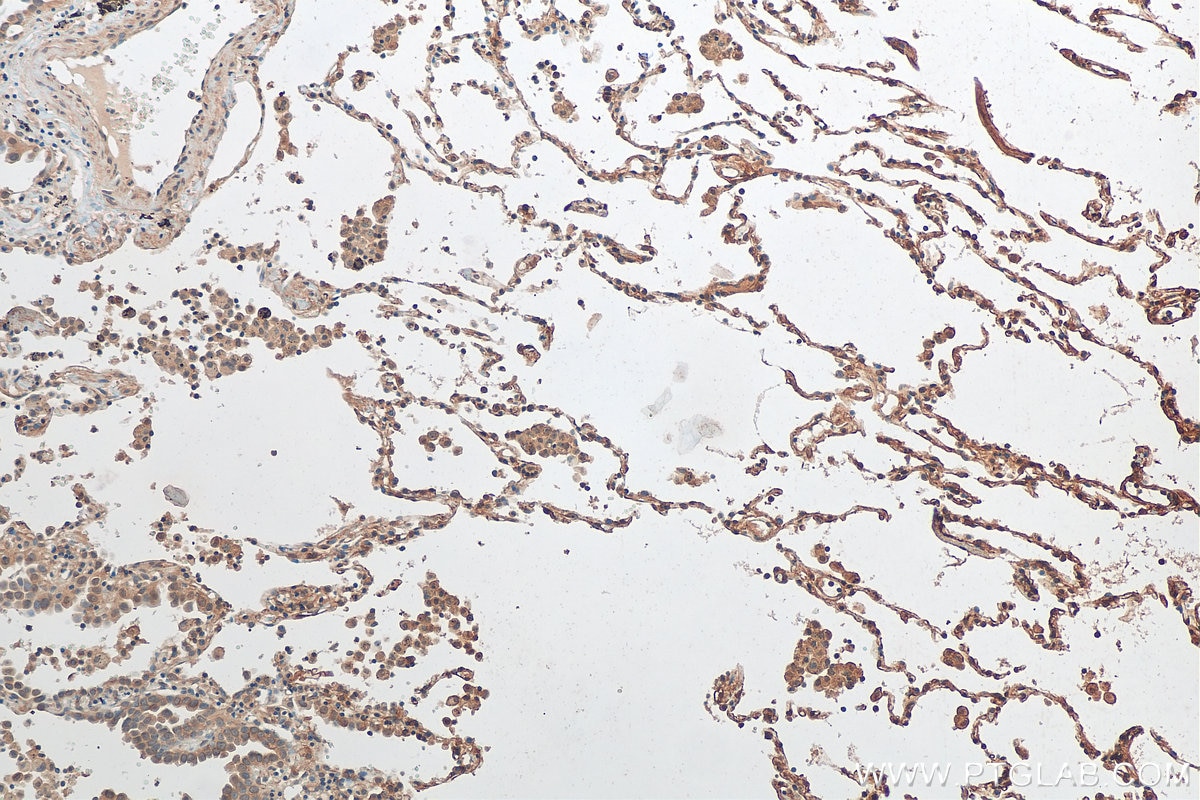 Immunohistochemistry (IHC) staining of human lung cancer tissue using CXorf22 Polyclonal antibody (20837-1-AP)