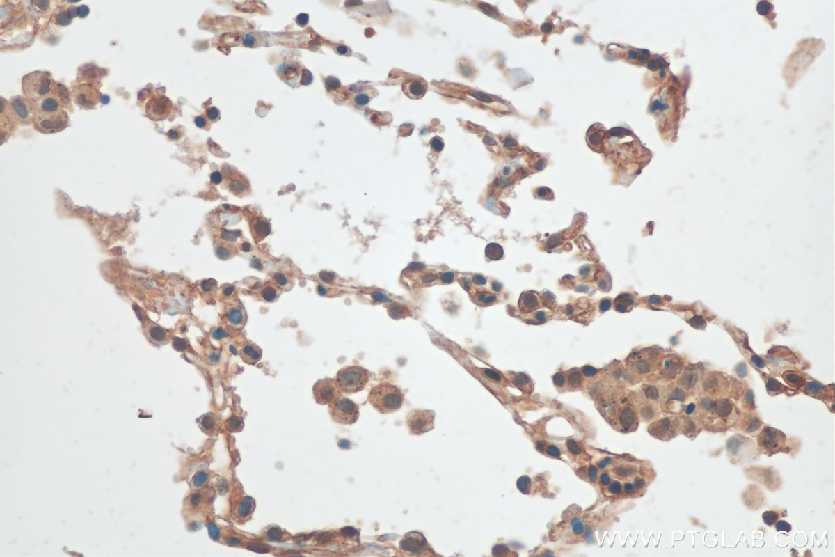 Immunohistochemistry (IHC) staining of human lung cancer tissue using CXorf22 Polyclonal antibody (20837-1-AP)