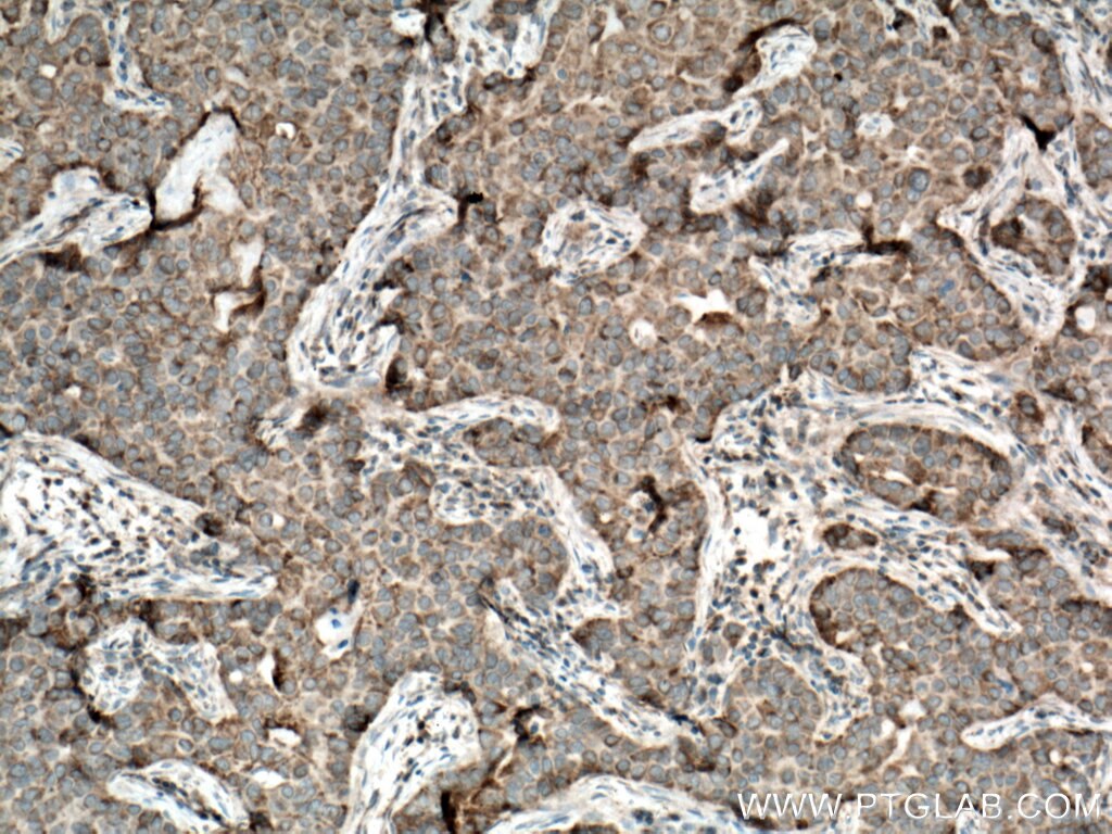Immunohistochemistry (IHC) staining of human breast cancer tissue using KK-LC-1 Polyclonal antibody (25708-1-AP)