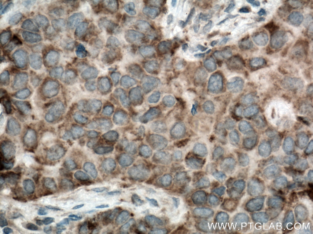 Immunohistochemistry (IHC) staining of human breast cancer tissue using KK-LC-1 Polyclonal antibody (25708-1-AP)