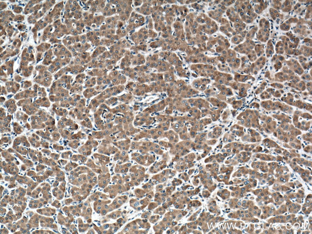 Immunohistochemistry (IHC) staining of human liver cancer tissue using Cytochrome b5 Polyclonal antibody (12365-1-AP)