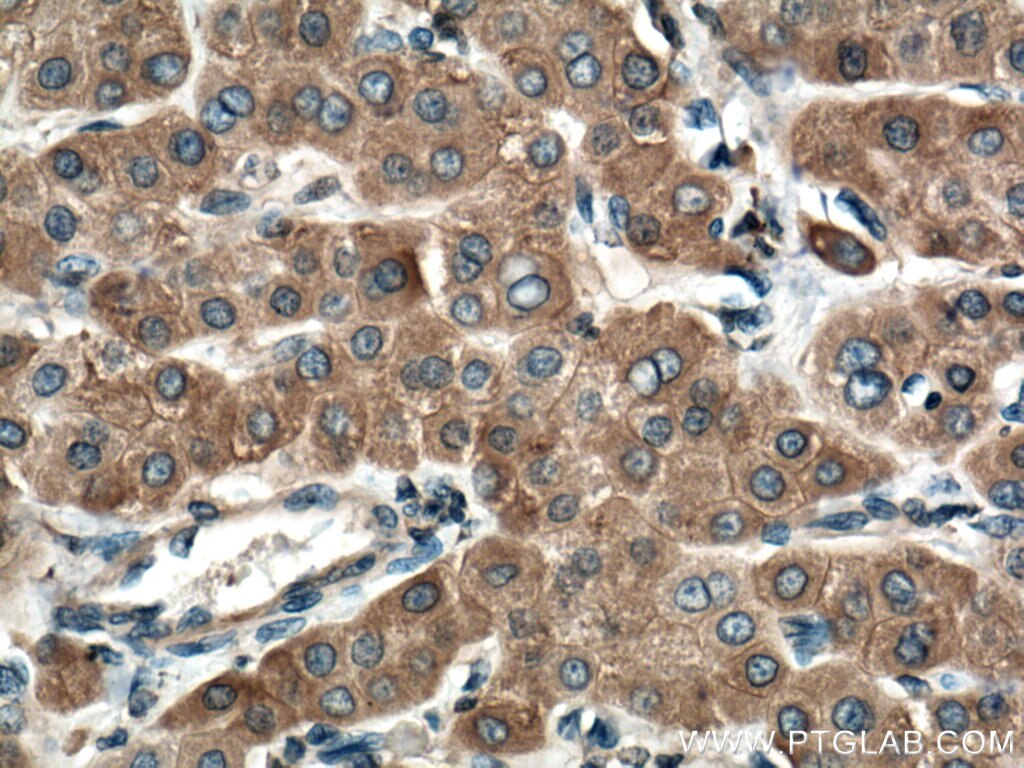 Immunohistochemistry (IHC) staining of human liver cancer tissue using Cytochrome b5 Polyclonal antibody (12365-1-AP)