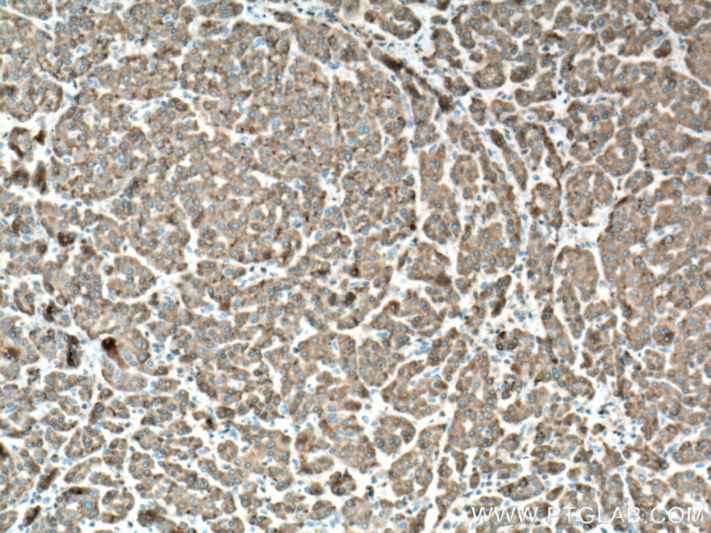 Immunohistochemistry (IHC) staining of human liver cancer tissue using Cytochrome b5 Polyclonal antibody (12365-1-AP)