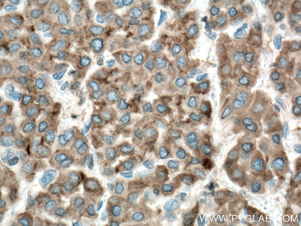 Immunohistochemistry (IHC) staining of human liver cancer tissue using Cytochrome b5 Polyclonal antibody (12365-1-AP)