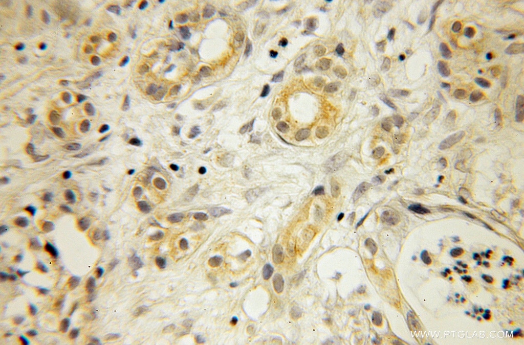 Immunohistochemistry (IHC) staining of human pancreas cancer tissue using Cytochrome b5 Polyclonal antibody (12365-1-AP)