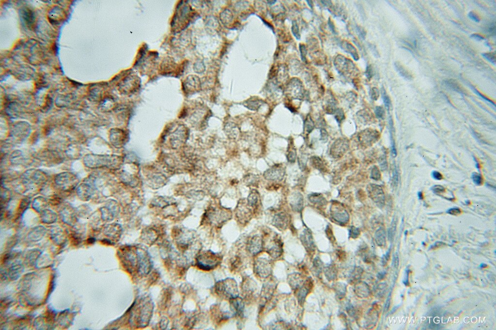 Immunohistochemistry (IHC) staining of human breast cancer tissue using CYB5R1 Polyclonal antibody (11807-1-AP)