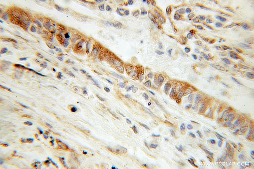 IHC staining of human lung cancer using 10894-1-AP