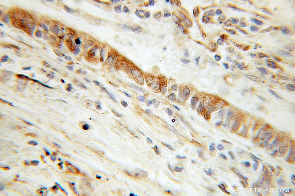 Immunohistochemistry (IHC) staining of human lung cancer tissue using CYB5R3 Polyclonal antibody (10894-1-AP)