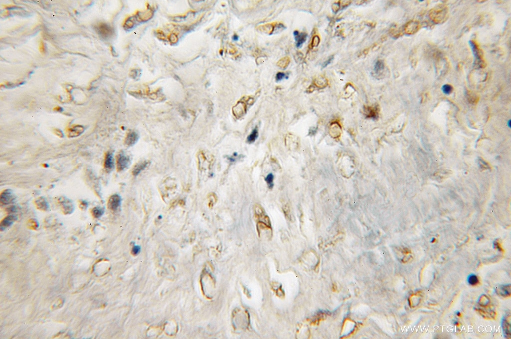 Immunohistochemistry (IHC) staining of human lung cancer tissue using CYB5R3 Polyclonal antibody (10894-1-AP)