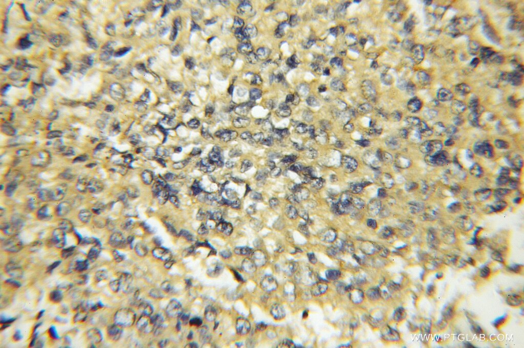 Immunohistochemistry (IHC) staining of human lung cancer tissue using CYB5R3 Polyclonal antibody (10894-1-AP)