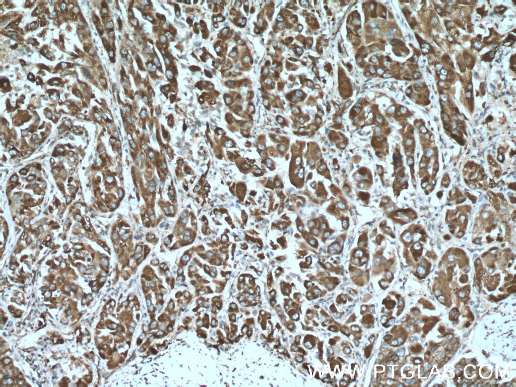 Immunohistochemistry (IHC) staining of human liver cancer tissue using CYB5R3 Monoclonal antibody (66022-1-Ig)