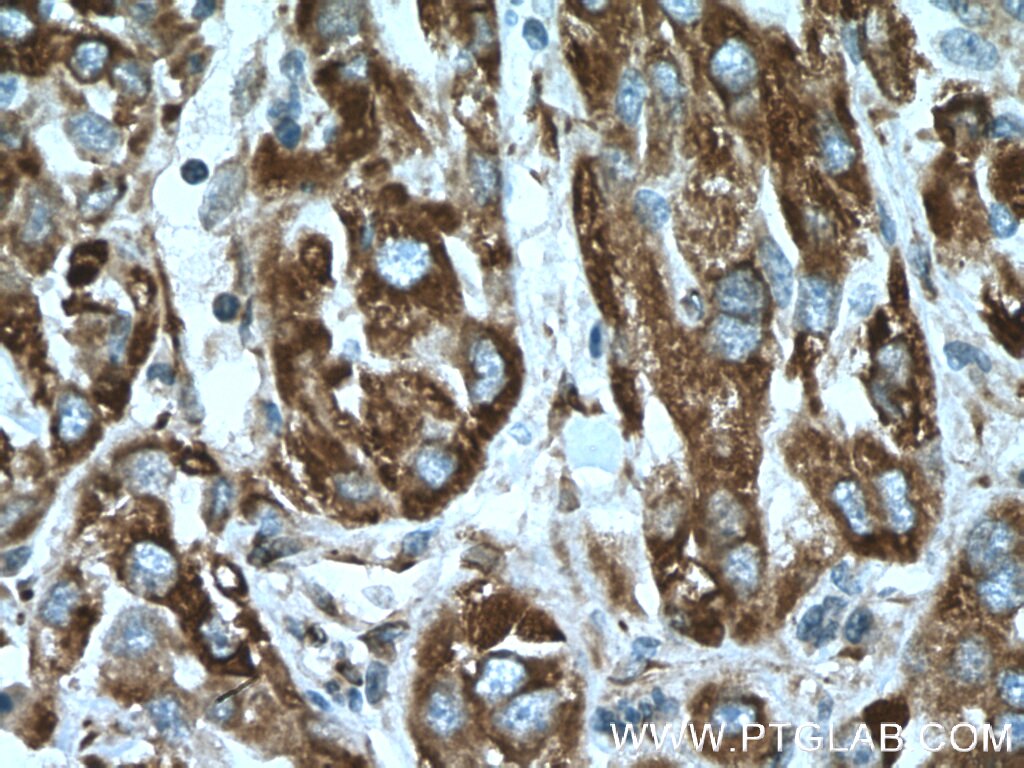 Immunohistochemistry (IHC) staining of human liver cancer tissue using CYB5R3 Monoclonal antibody (66022-1-Ig)