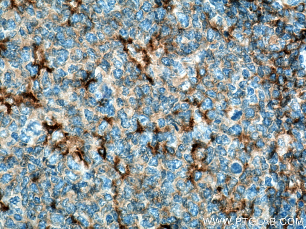 Immunohistochemistry (IHC) staining of human tonsillitis tissue using NOX2 Polyclonal antibody (19013-1-AP)