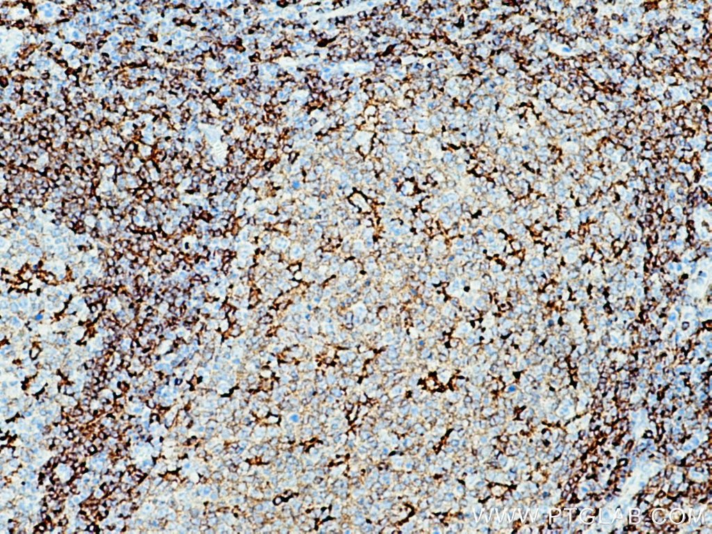 Immunohistochemistry (IHC) staining of human tonsillitis tissue using NOX2 Polyclonal antibody (19013-1-AP)