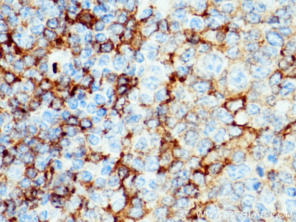 Immunohistochemistry (IHC) staining of human tonsillitis tissue using NOX2 Polyclonal antibody (19013-1-AP)