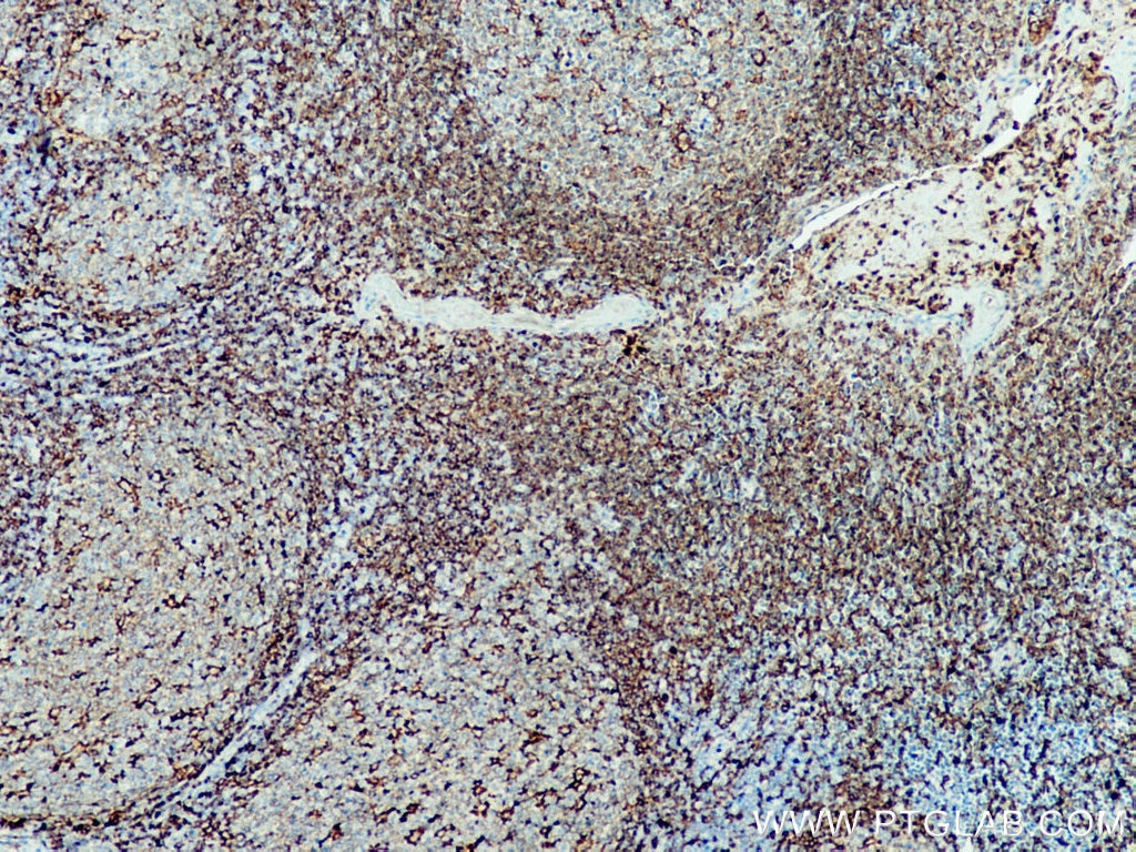 Immunohistochemistry (IHC) staining of human tonsillitis tissue using NOX2 Polyclonal antibody (19013-1-AP)