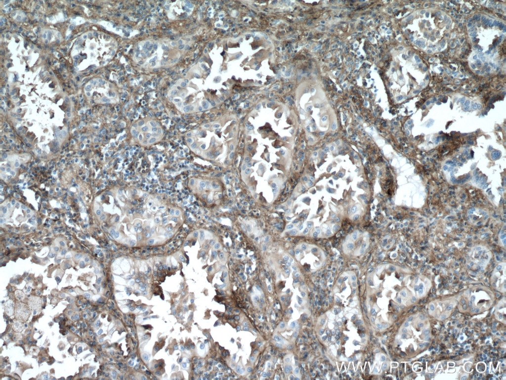Immunohistochemistry (IHC) staining of human lung cancer tissue using CYBRD1 Polyclonal antibody (26735-1-AP)