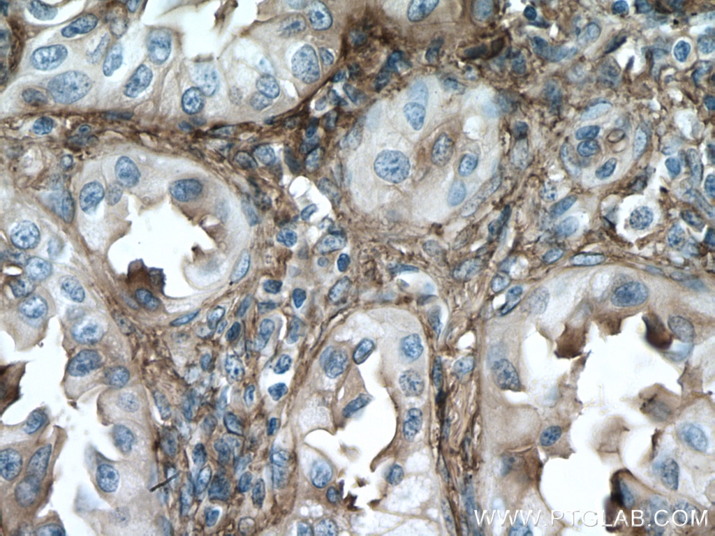 Immunohistochemistry (IHC) staining of human lung cancer tissue using CYBRD1 Polyclonal antibody (26735-1-AP)