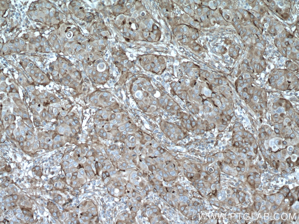 IHC staining of human breast cancer using 26735-1-AP