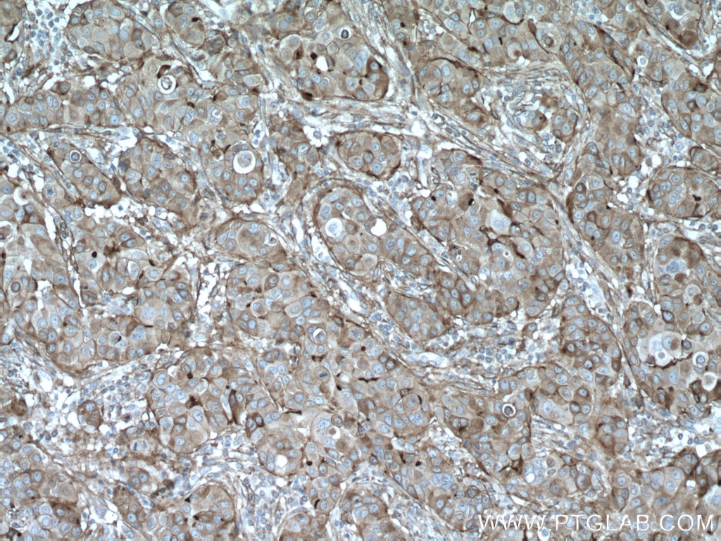 Immunohistochemistry (IHC) staining of human breast cancer tissue using CYBRD1 Polyclonal antibody (26735-1-AP)