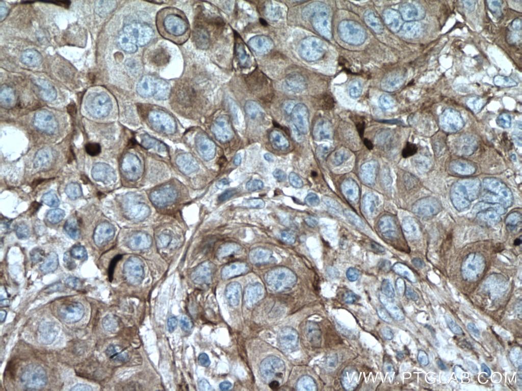 Immunohistochemistry (IHC) staining of human breast cancer tissue using CYBRD1 Polyclonal antibody (26735-1-AP)