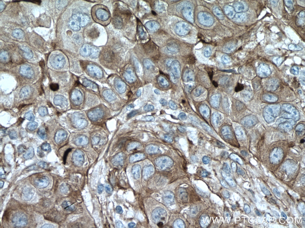 Immunohistochemistry (IHC) staining of human breast cancer tissue using CYBRD1 Polyclonal antibody (26735-1-AP)