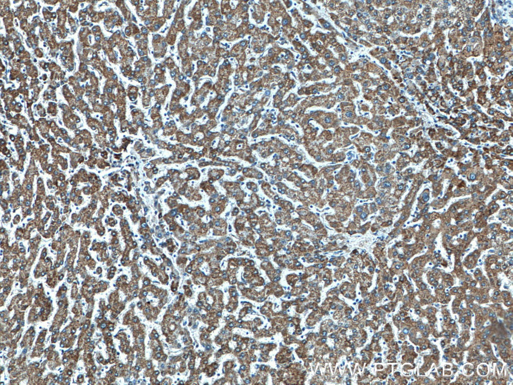 Immunohistochemistry (IHC) staining of human liver cancer tissue using CYC1 Polyclonal antibody (10242-1-AP)