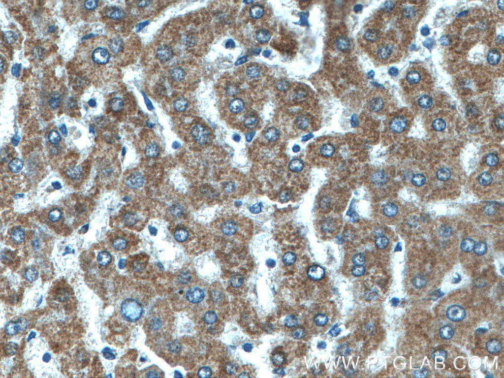 Immunohistochemistry (IHC) staining of human liver cancer tissue using CYC1 Polyclonal antibody (10242-1-AP)