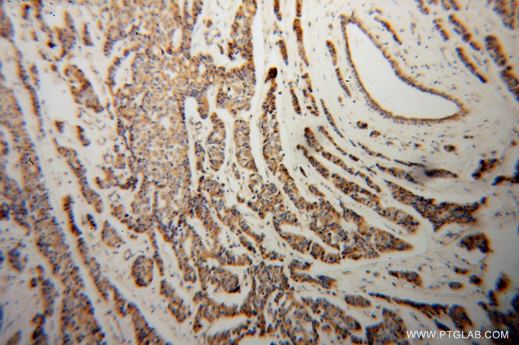 Immunohistochemistry (IHC) staining of human breast cancer tissue using CYC1 Polyclonal antibody (10242-1-AP)