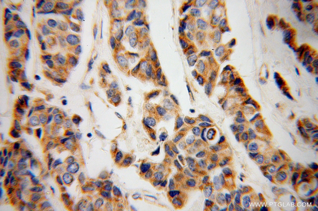 Immunohistochemistry (IHC) staining of human breast cancer tissue using CYC1 Polyclonal antibody (10242-1-AP)